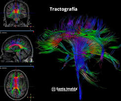 Tractografía ecrebral